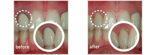 zirconia abutment01